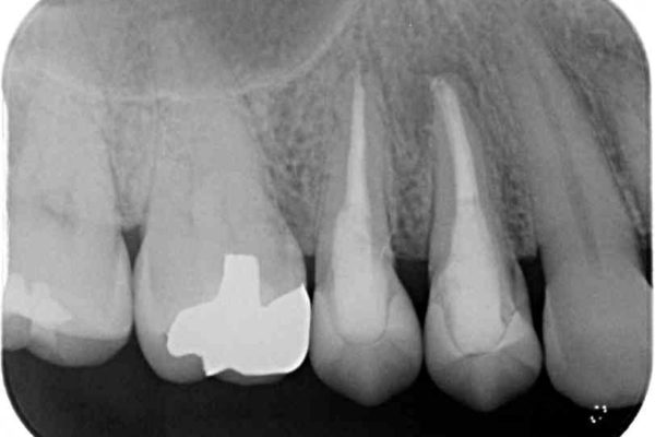 治療途中で放置していた歯　オールセラミッククラウンによる補綴治療 治療後画像