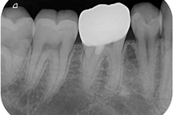神経近くにまで及んだ大きなむし歯のセラミッククラウン 治療後画像