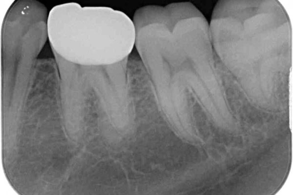 神経近くにまで及んだ大きなむし歯のセラミッククラウン 治療後画像