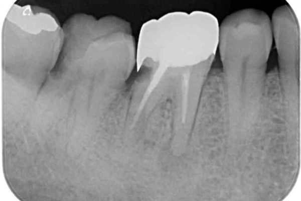 骨の中にまで及んだ深い虫歯　歯周外科処置を用いた補綴治療 治療前画像