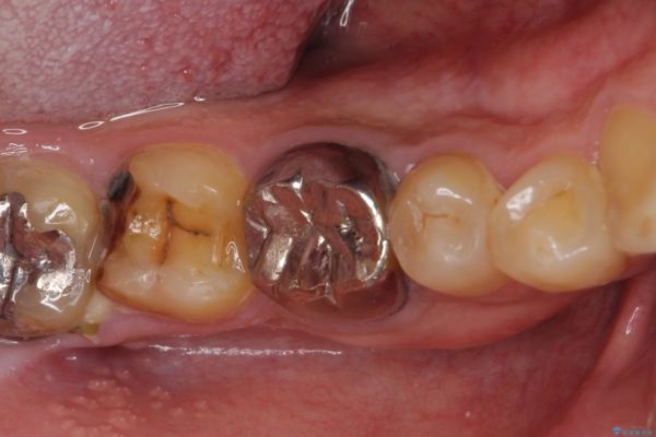 骨の中にまで及んだ深い虫歯　歯周外科処置を用いた補綴治療 治療前画像