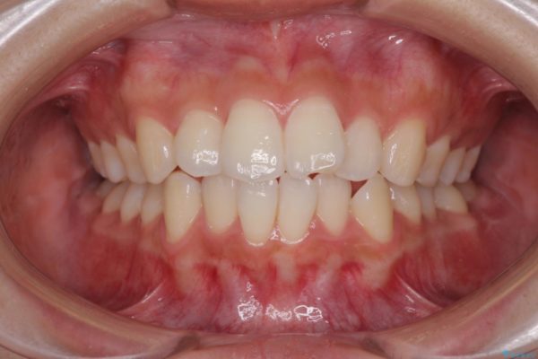 前歯のデコボコと突出感を改善したい　インビザラインによる矯正治療 ビフォー