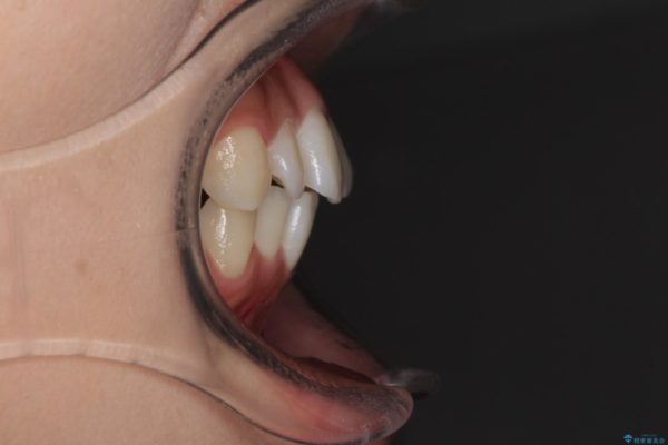 前歯のデコボコと突出感を改善したい　インビザラインによる矯正治療 治療前画像