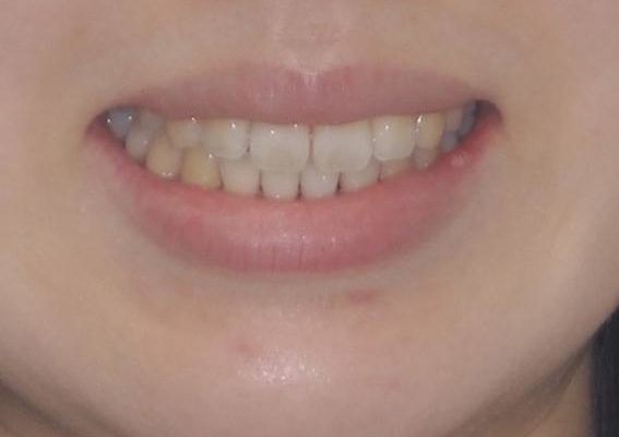 インビザラインで気になる前歯を綺麗に整える 治療後画像