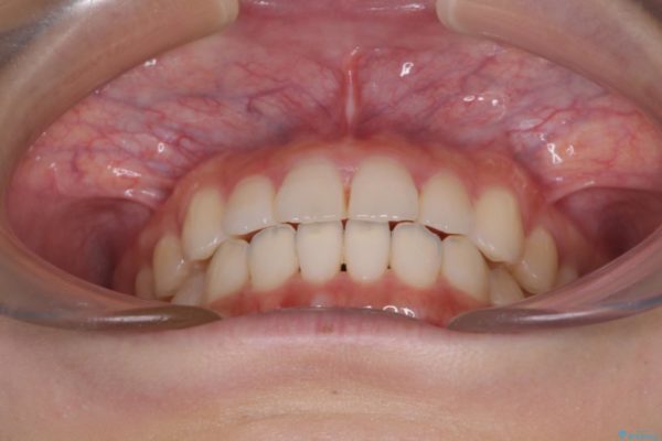 気になる前歯を整えたい　インビザライン・ライトでの矯正治療 治療後画像
