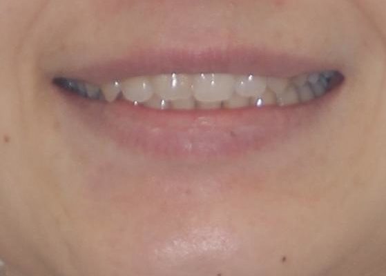 倒れた奥歯を改善　インビザラインでの矯正治療 治療後画像