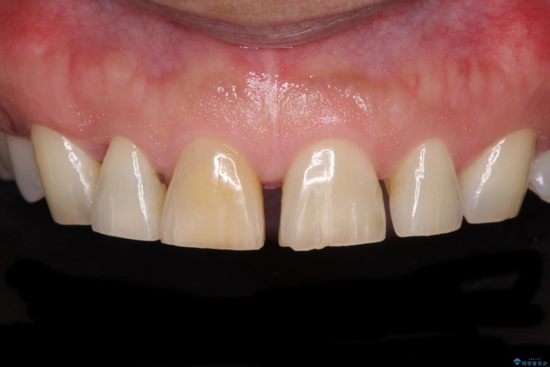前歯の隙間を閉じたい　ラミネートベニアによる審美歯科治療 治療前
