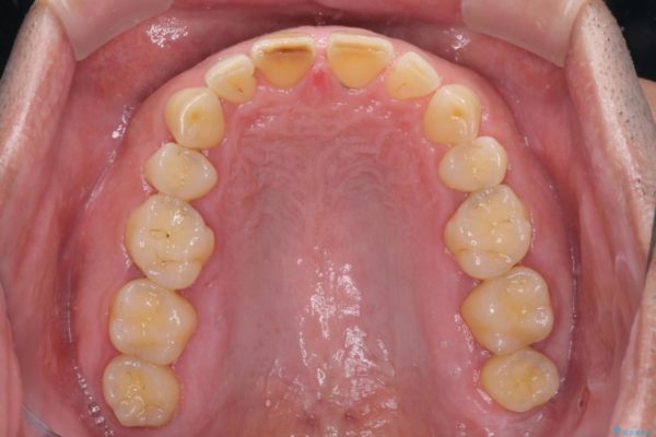 前歯の隙間を閉じたい　ラミネートベニアによる審美歯科治療 治療前画像