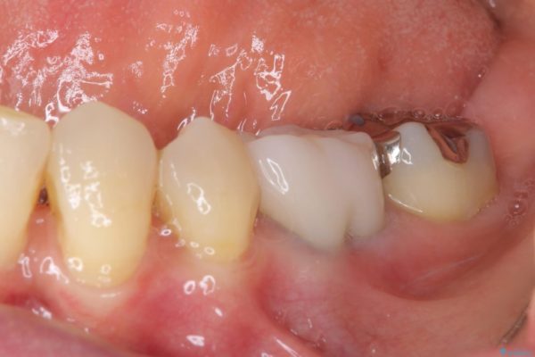 他院で入れた仮歯が不快　当院で使用感の良いオールセラミックブリッジに 治療後画像