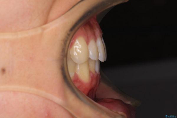 口が少し閉じにくい　インビザラインによる非抜歯矯正 治療後画像