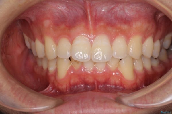口が少し閉じにくい　インビザラインによる非抜歯矯正 治療前画像