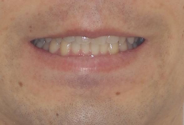 前歯の咬み合わせとデコボコを解消　インビザラインによる矯正治療 治療後画像