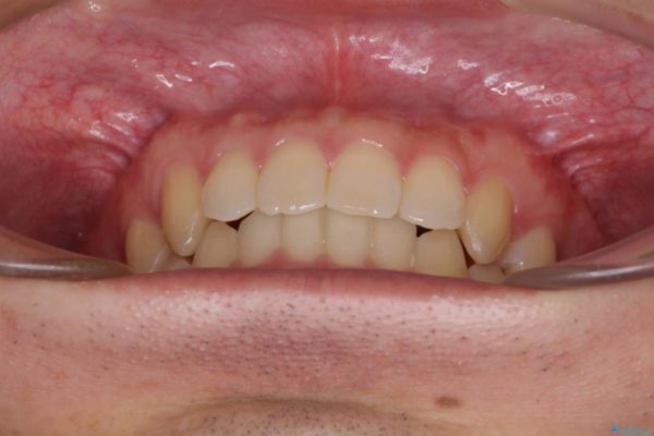 前歯の咬み合わせとデコボコを解消　インビザラインによる矯正治療 治療後画像