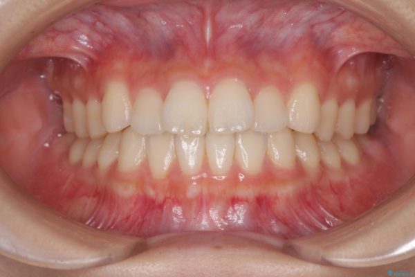 気になる前歯を整えたい　インビザライン・ライトでの矯正治療 治療前画像