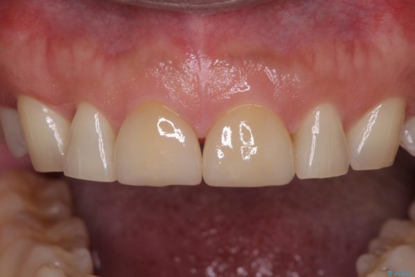 前歯の隙間を閉じたい　ラミネートベニアによる審美歯科治療 治療後画像