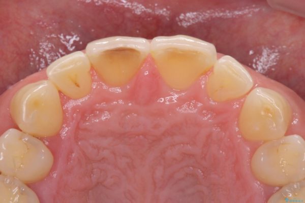前歯の隙間を閉じたい　ラミネートベニアによる審美歯科治療 治療後画像