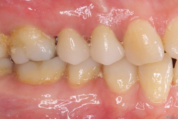 治療途中で放置していた歯　オールセラミッククラウンによる補綴治療 治療後画像