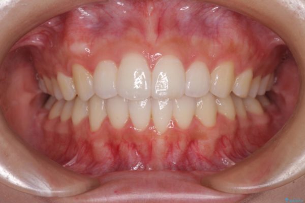 前歯のデコボコと突出感を改善したい　インビザラインによる矯正治療 アフター