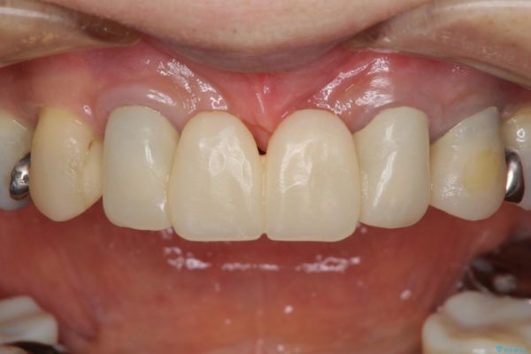 他院で入れた仮歯が不快　当院で使用感の良いオールセラミックブリッジに 治療前画像