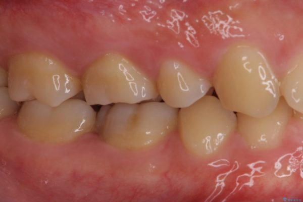 神経近くにまで及んだ大きなむし歯のセラミッククラウン 治療前画像