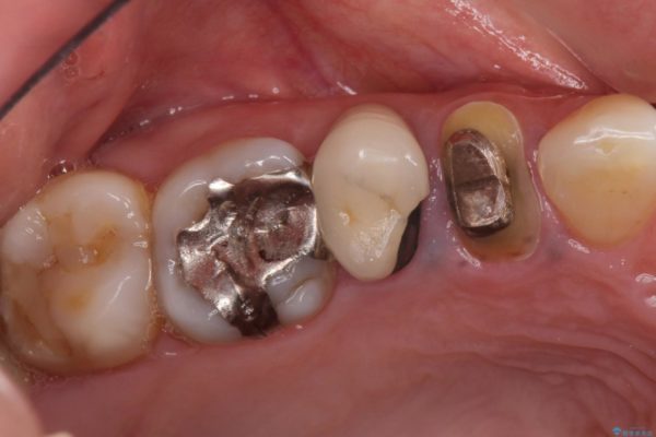 治療途中で放置していた歯　オールセラミッククラウンによる補綴治療 治療前画像