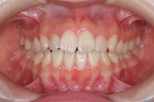インビザラインで気になる前歯を綺麗に整える 治療前画像