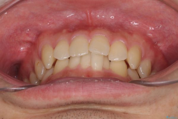 前歯の咬み合わせとデコボコを解消　インビザラインによる矯正治療 治療前画像