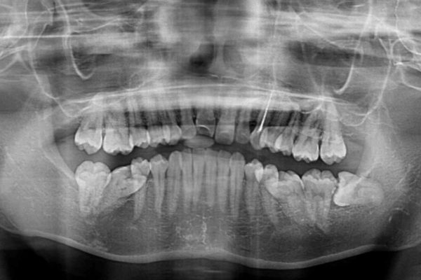 倒れた奥歯を改善　インビザラインでの矯正治療 治療前画像