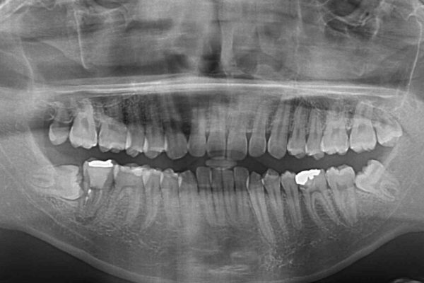 口が少し閉じにくい　インビザラインによる非抜歯矯正 治療前画像