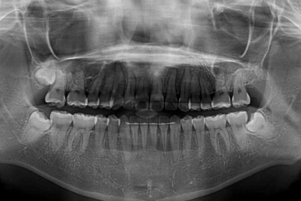 インビザラインで気になる前歯を綺麗に整える 治療後画像
