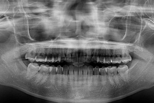 気になる前歯を整えたい　インビザライン・ライトでの矯正治療 治療後画像