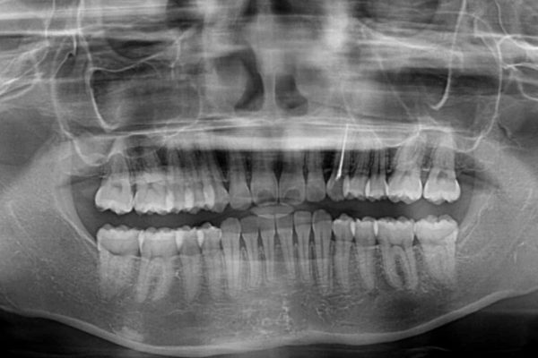 倒れた奥歯を改善　インビザラインでの矯正治療 治療後画像