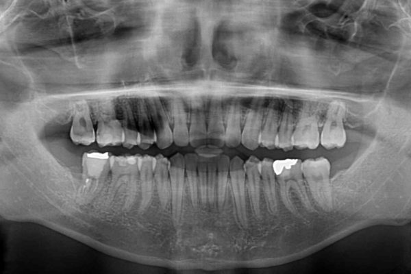 口が少し閉じにくい　インビザラインによる非抜歯矯正 治療後画像