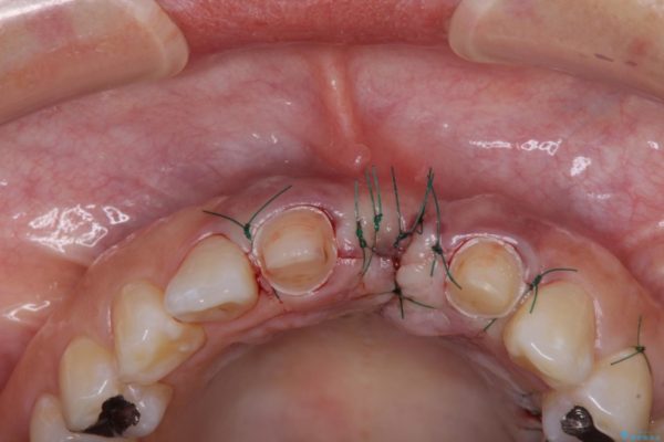 前歯のブリッジがアンバランス　歯肉移植術を併用した前歯のブリッジ 治療後画像