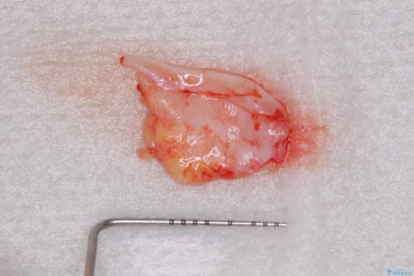 前歯のブリッジがアンバランス　歯肉移植術を併用した前歯のブリッジ 治療前画像