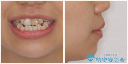 抜歯矯正で八重歯を改善　費用を抑えた装置 治療前画像