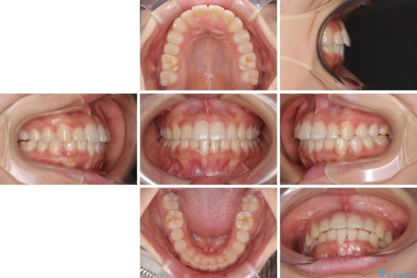 ワイヤー矯正で短期間での歯列矯正 治療後画像