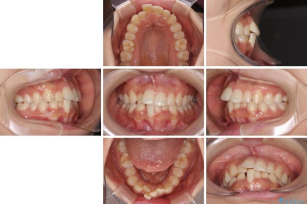 ワイヤー矯正で短期間での歯列矯正 治療前画像
