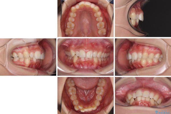 デコボコの前歯を治したい　インビザラインによる矯正治療 治療前画像
