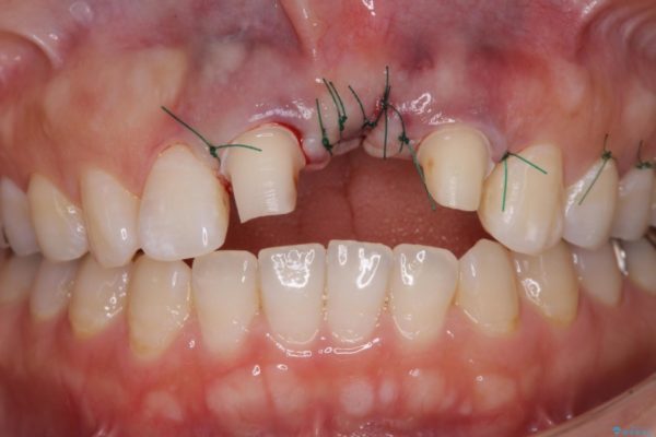 前歯のブリッジがアンバランス　歯肉移植術を併用した前歯のブリッジ 治療後画像