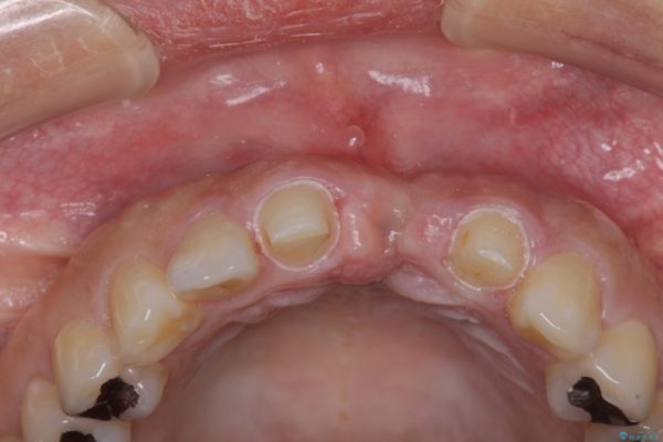前歯のブリッジがアンバランス　歯肉移植術を併用した前歯のブリッジ 治療前画像