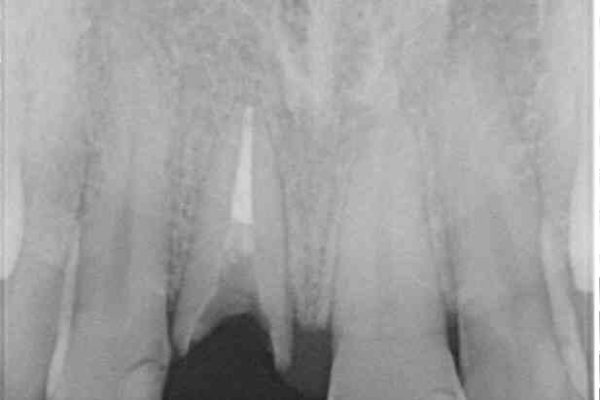抜歯が必要な前歯　インプラントによる補綴治療 治療前画像