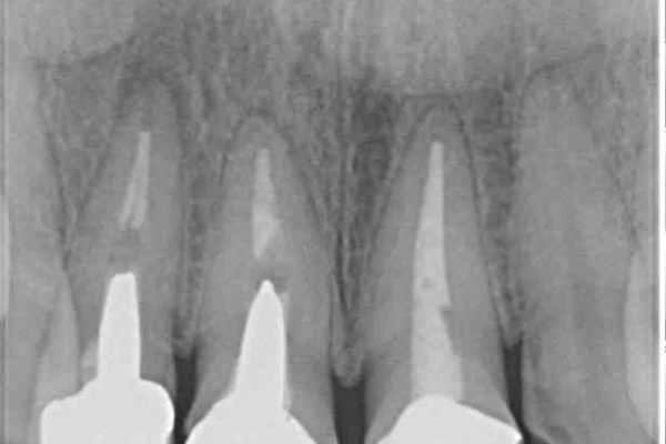 前歯の審美歯科治療　オールセラミッククラウンと下顎の部分矯正 治療前画像