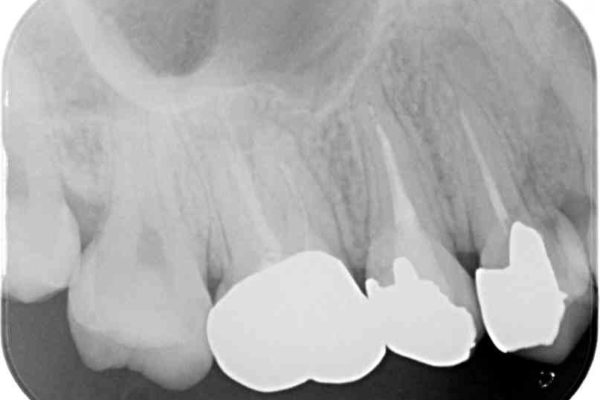 結婚式前に目立つ銀歯を自然なセラミックに 治療前画像
