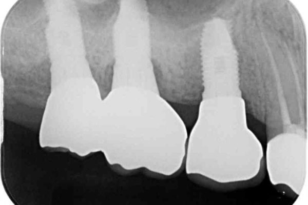 強い咬合力で折れてしまった歯　インプラントによる補綴治療 治療後画像