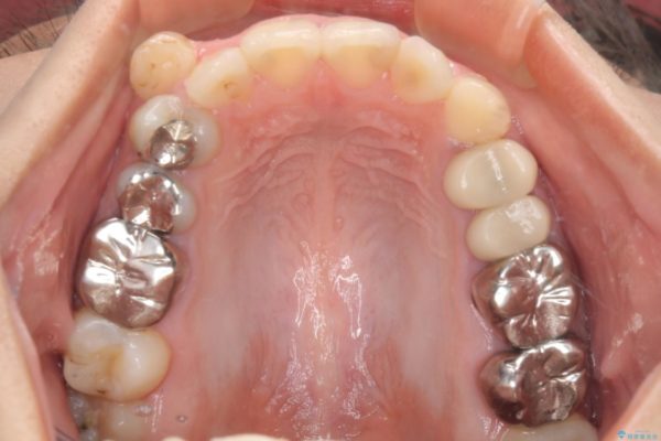結婚式前に目立つ銀歯を自然なセラミックに 治療前画像