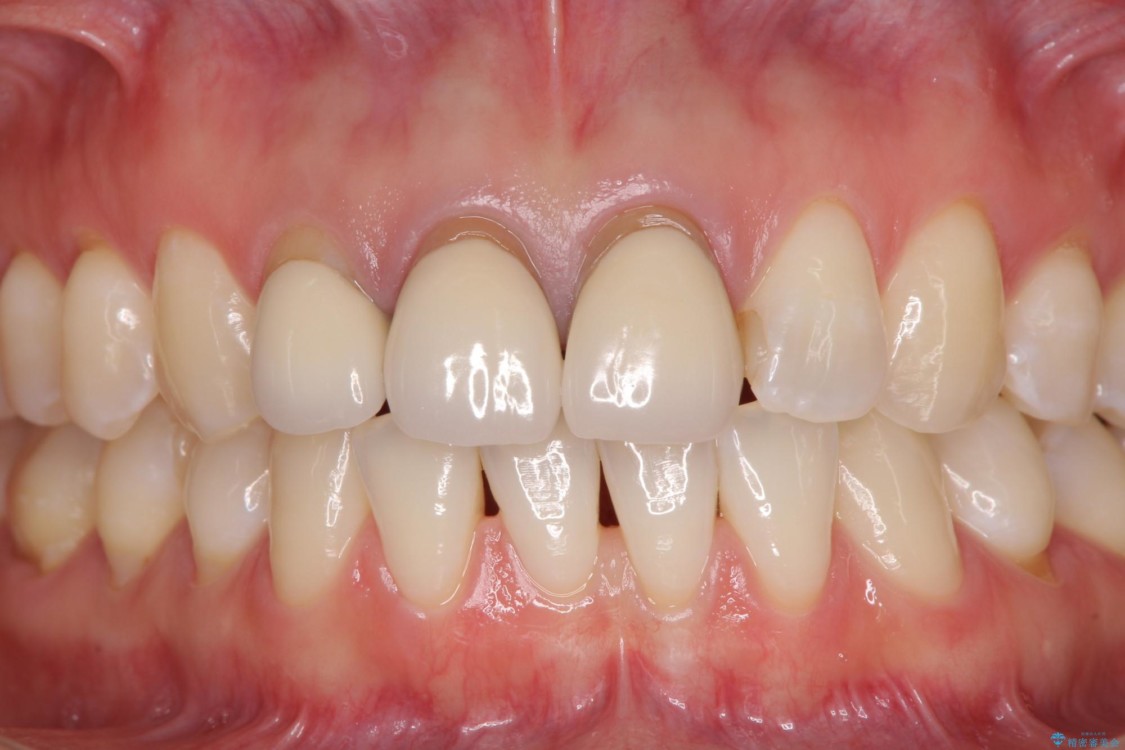 前歯の審美歯科治療　オールセラミッククラウンと下顎の部分矯正 ビフォー