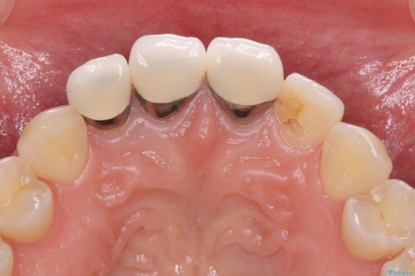 前歯の審美歯科治療　オールセラミッククラウンと下顎の部分矯正 治療前画像