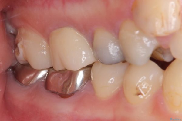 結婚式前に目立つ銀歯を自然なセラミックに 治療後画像