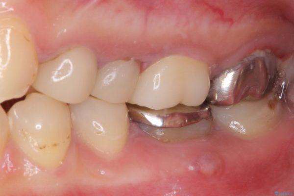 結婚式前に目立つ銀歯を自然なセラミックに 治療後画像